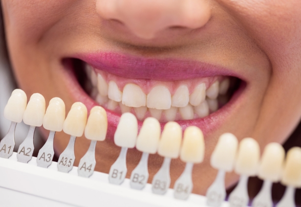 Facings behandeling - IJssel Dental