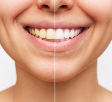 Smile Make Over - IJssel Dental