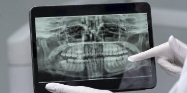 Diagnostiek en Röntgenfoto's behandeling - IJssel Dental