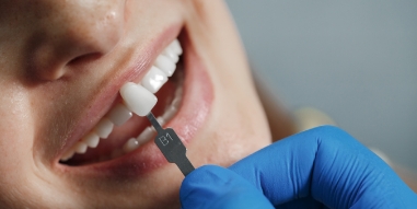 Facings behandeling - IJssel Dental