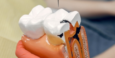 Parodontologie​ behandeling - IJssel Dental