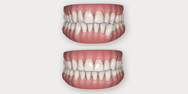 Invisalign behandelingen