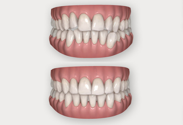 Invisalign behandelingen