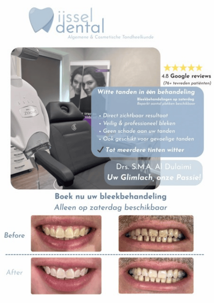 Teeth Whitening Zwolle at IJssel Dental